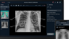 Chest X-ray analysis report 