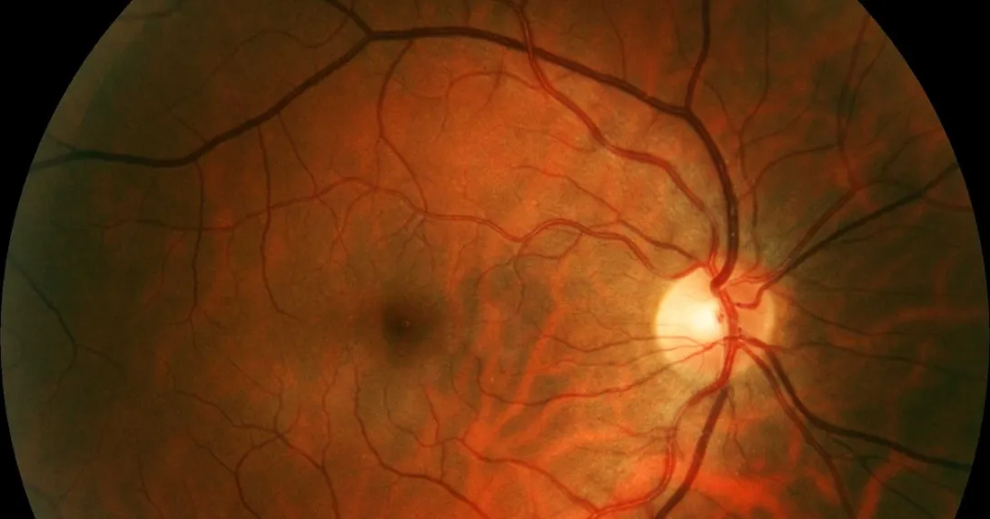 Retinal image Retinal image