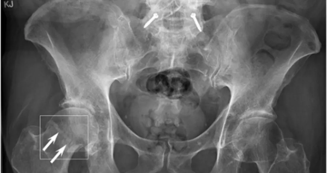 An image of the software detecting a fracture near a patient's hip